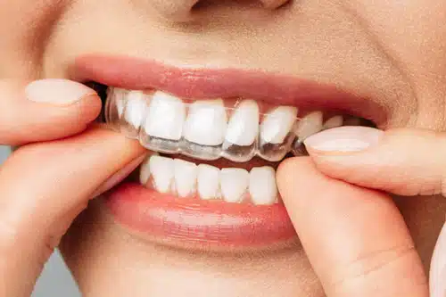 Close-up of a hand placing a clear Invisalign aligner on teeth at Delta Smiles in Antioch and Brentwood, CA