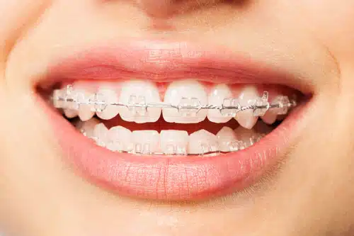 Close-up of a smile with clear ceramic braces at Delta Smiles in Antioch and Brentwood, CA