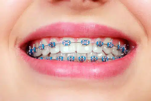 Close-up of a smile with traditional metal braces at Delta Smiles in Antioch and Brentwood, CA
