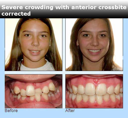 Before and after comparison of a patient's face and smile showing severe crowding with an anterior crossbite corrected at Delta Smiles in Antioch and Brentwood, CA